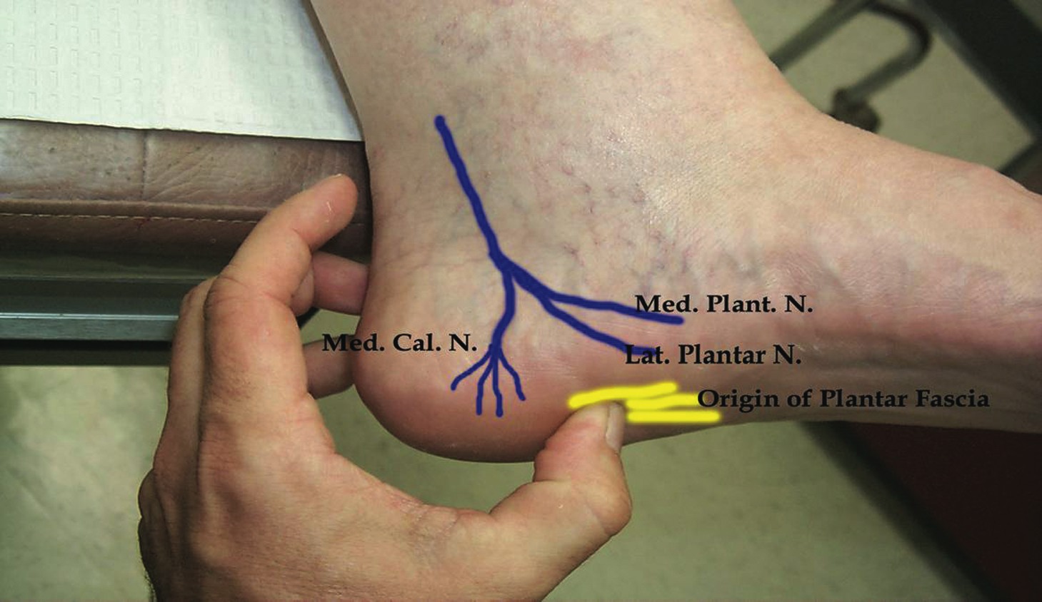 How do you treat foot pain from nerve damage?
